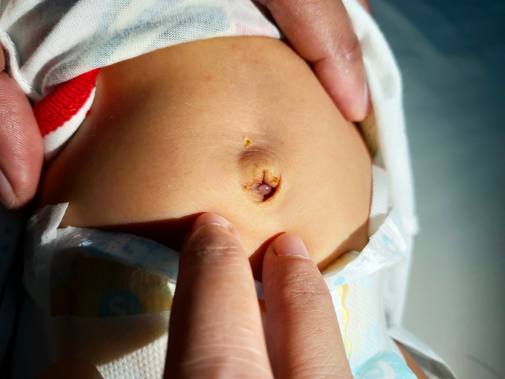 A baby's infected belly button with an adult's hand gently touching their stomach around the belly button.